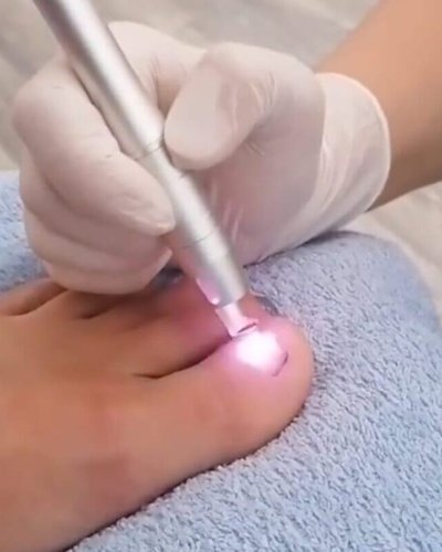 Dioden-Laser-gegen-Nagelpilz