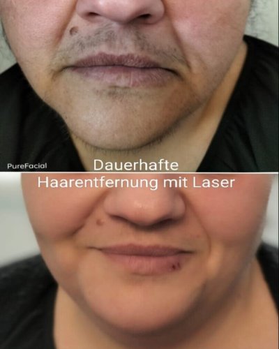 SHR-IPLRF-Dauerhafte-Haarentfernung-1