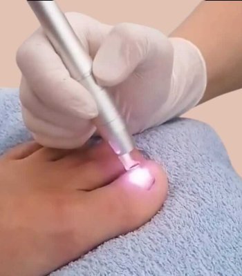 Dioden-Laser-gegen-Nagelpilz_1