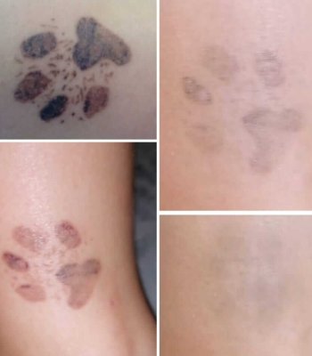 Tattooentfernung